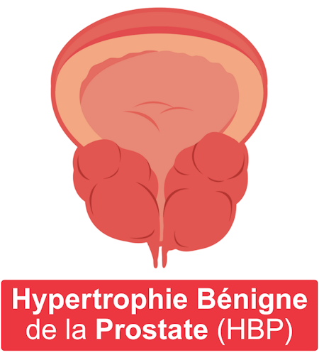 Prostaless - Hypertrophie Benigne