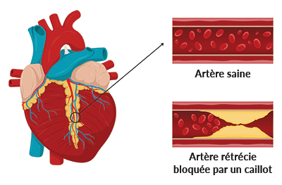 schema coeur crise cardiaque - Naturoscience